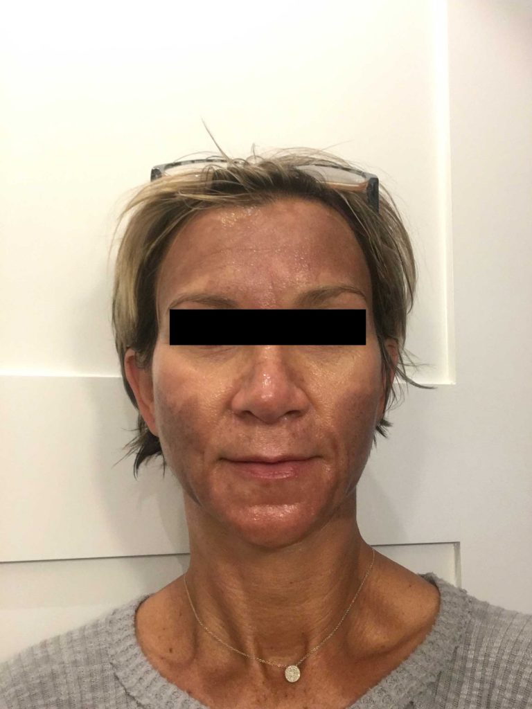 Corrective Peel - Day 1