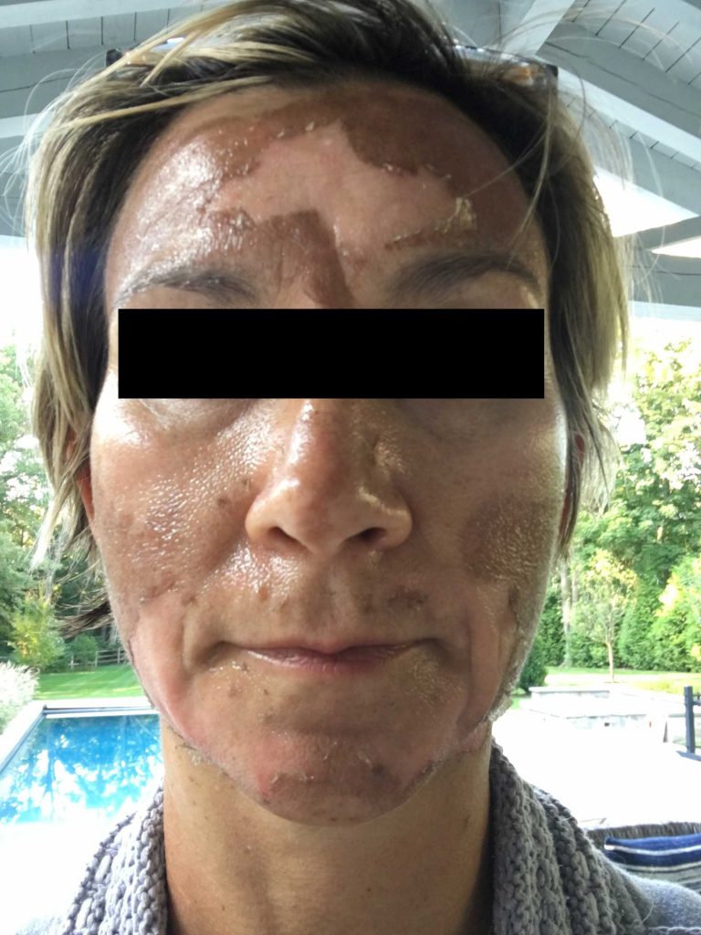 Corrective Peel - Day 4