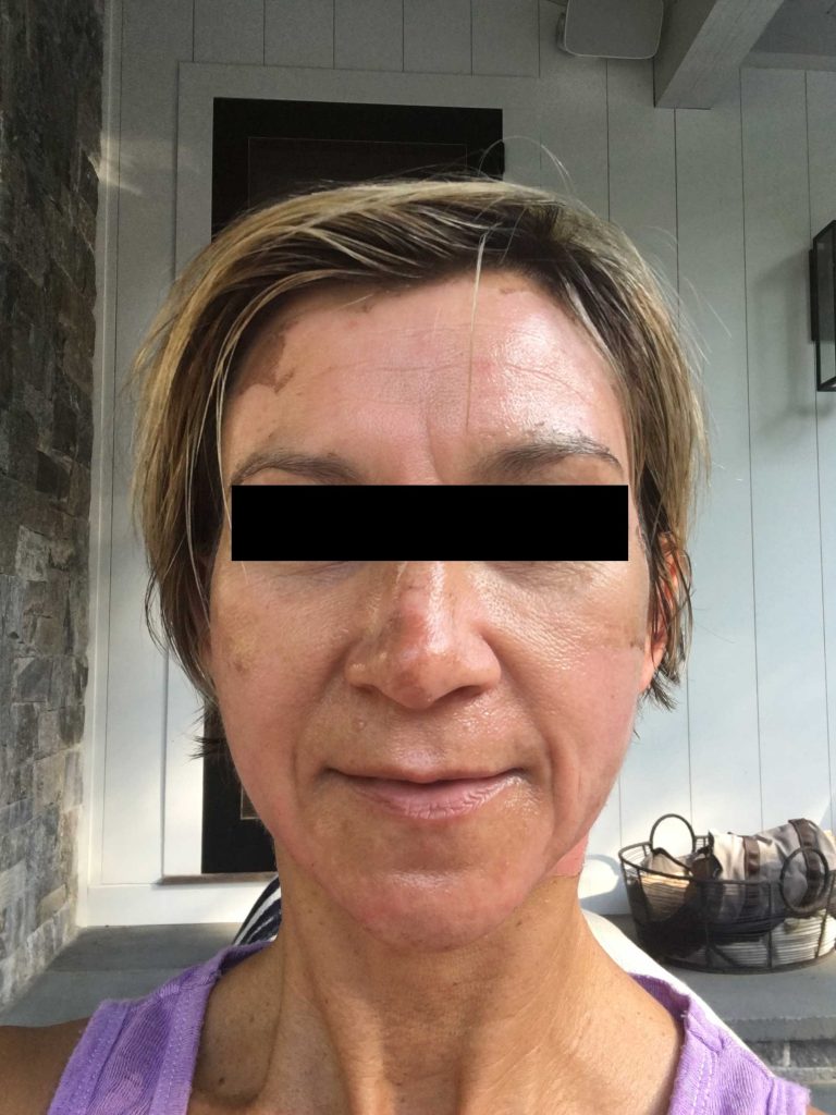 Corrective Peel - Day 5